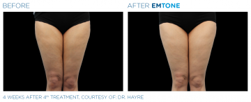 cellulite in legs | before and after photo | Coral Spring Med Spa | Coral Springs, FL