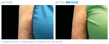 Emrone for arms | before and after photo | Coral Spring Med Spa | Coral Springs, FL