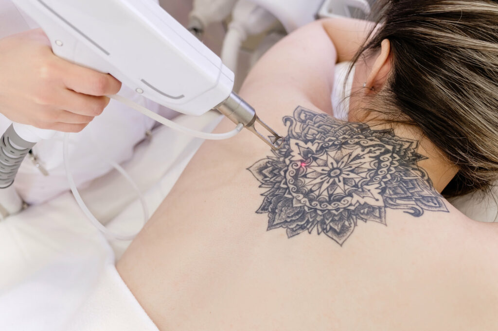 Tatto-removal Treatment | Coral Springs Med Spa in Coral Springs, FL