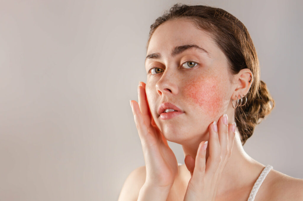 Face of a man with flushed cheek skin. Before rosacea laser treatment. | Coral Springs Med Spa in Coral Springs, FL