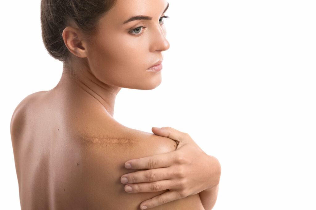 Woman with a scar on her shoulder | Coral Springs Med Spa in Coral Springs, FL