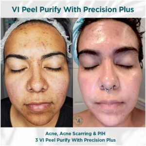 acne acne scarring | before and after photo | Coral Spring Med Spa | Coral Springs, FL