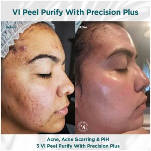 acne treatment | VI Peel Purify | before and after photo | Coral Spring Med Spa | Coral Springs, FL