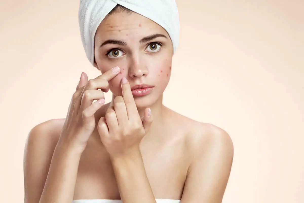 Acne Therapy by Coral Springs Medspa in Coral Springs FL