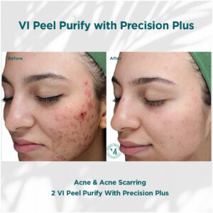 Acne and acne scarring treatment | before and after photo | Coral Spring Med Spa | Coral Springs, FL