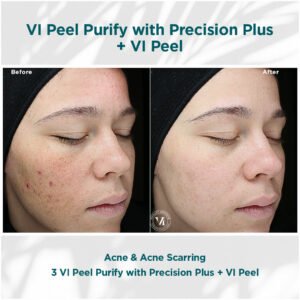 VI Peel Purify with Precision Plus | before and after photo | Coral Spring Med Spa | Coral Springs, FL