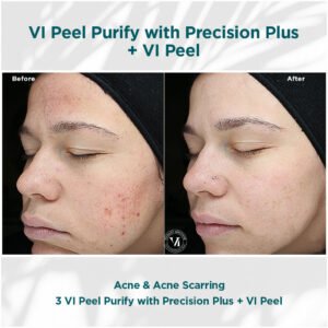 VI Peel Purify for acne and acne scarring | before and after photo | Coral Spring Med Spa | Coral Springs, FL