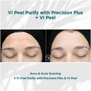 Vi Peel Purify | acne scars | before and after photo | Coral Spring Med Spa | Coral Springs, FL