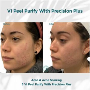 acne and acne scarring reduction | before and after photo | Coral Spring Med Spa | Coral Springs, FL