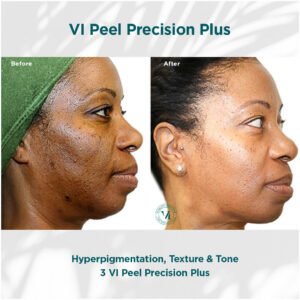 Hyperpigmentation treatment | before and after photo | Coral Spring Med Spa | Coral Springs, FL