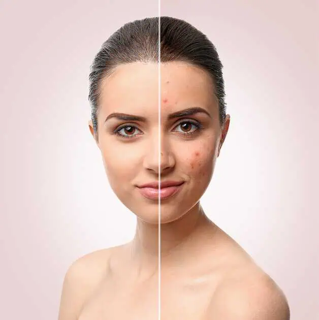 Acne Therapy in Coral Springs, FL by Coral Springs Med Spa