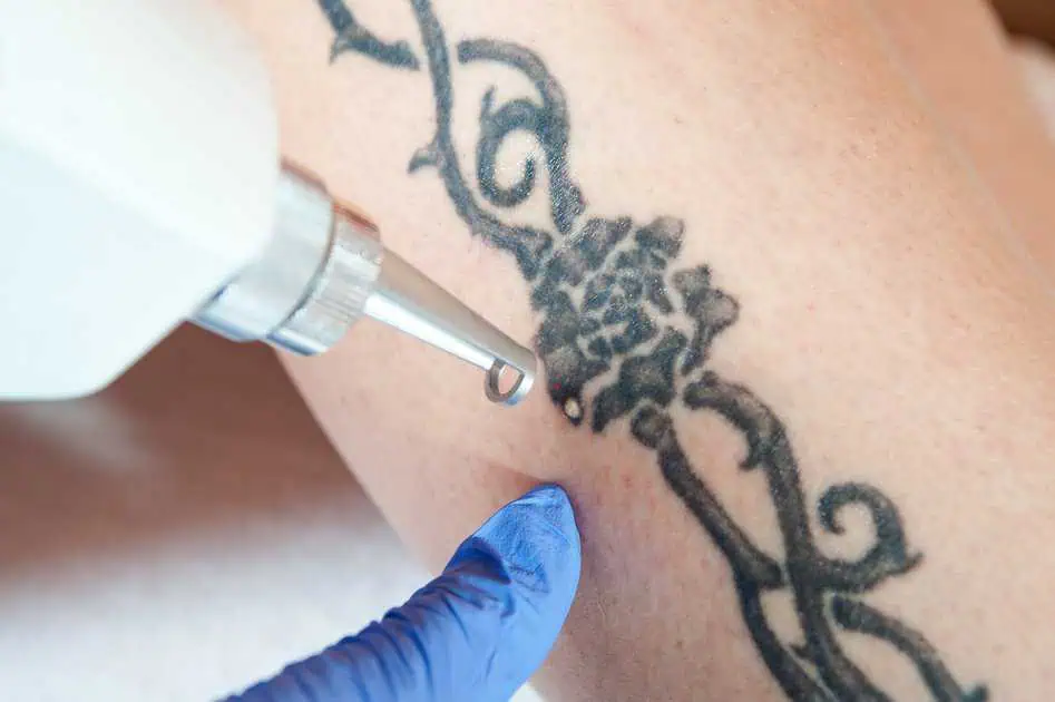 Tattoo Removal in Coral Springs, FL by Coral Springs Med Spa