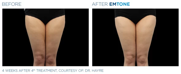 Emtone for legs | before and after photo | Coral Spring Med Spa | Coral Springs, FL