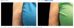 Emtone for hands | before and after photo | Coral Spring Med Spa | Coral Springs, FL