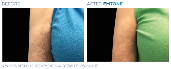 Emtone for hands | before and after photo | Coral Spring Med Spa | Coral Springs, FL