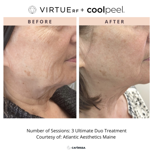 VirtueRF + CoolPeel for wrinkles on face | before and after photo | Coral Spring Med Spa | Coral Springs, FL