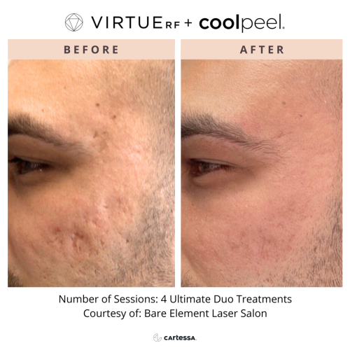 VirtueRF + CoolPeel for acne scars | before and after photo | Coral Spring Med Spa | Coral Springs, FL