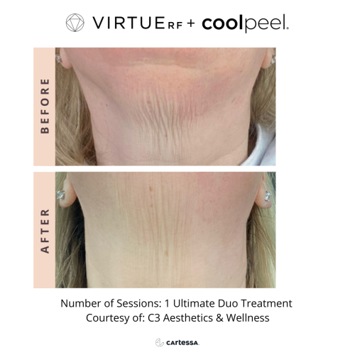 VirtueRF + CoolPeel for neck sagging skin | before and after photo | Coral Spring Med Spa | Coral Springs, FL