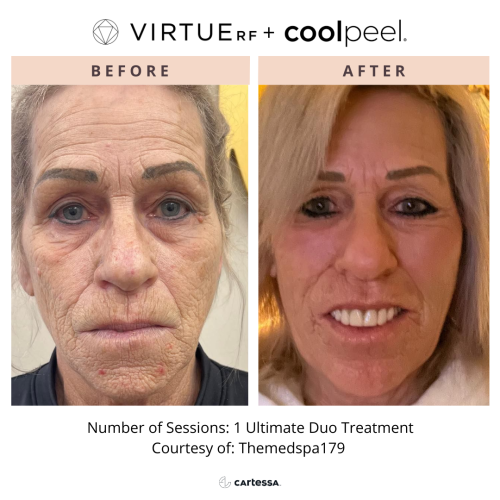 VirtueRF + CoolPeel for wrinkles | before and after photo | Coral Spring Med Spa | Coral Springs, FL