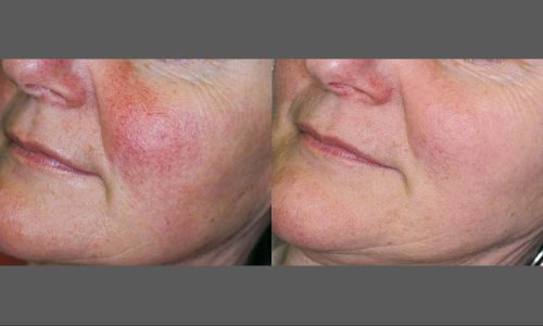 IPL Photofacial Treatment before and after | Coral Springs Med Spa in Coral Springs, FL