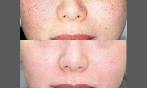 IPL Photofacial Treatment before and after | Coral Springs Med Spa in Coral Springs, FL
