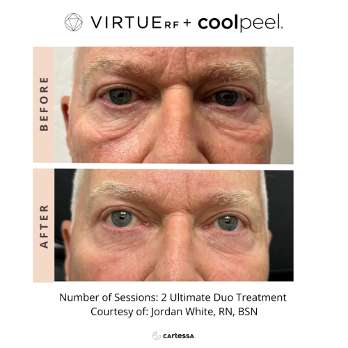 VirtueRF + CoolPeel | under eye bags | before and after photo | Coral Spring Med Spa | Coral Springs, FL