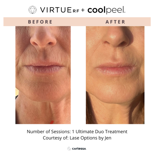 VirtueRF + CoolPeel | Ultimate duo treatment | before and after photo | Coral Spring Med Spa | Coral Springs, FL