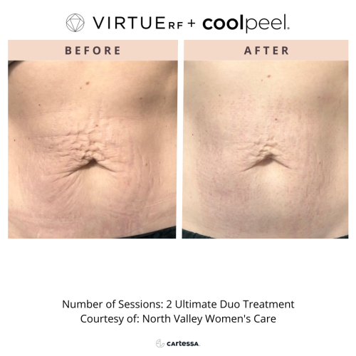 VirtueRF + CoolPeel for body | before and after photo | Coral Spring Med Spa | Coral Springs, FL