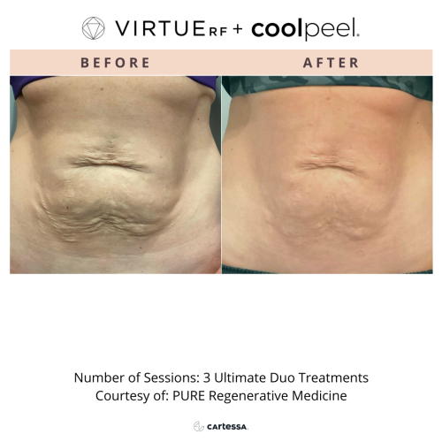 VirtueRF + CoolPeel Duo treatments | before and after photo | Coral Spring Med Spa | Coral Springs, FL