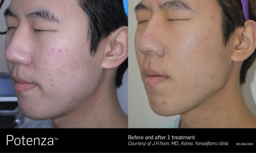 Potenza Treatment before and after | Coral Springs Med Spa in Coral Springs, FL