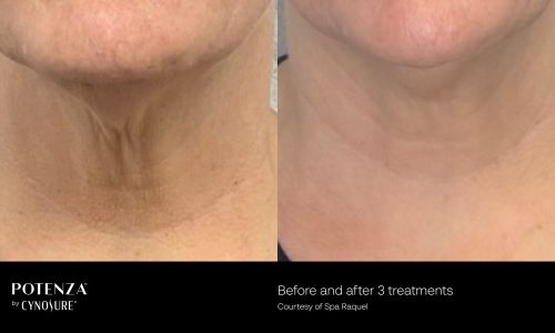 Potenza Treatment before and after | Coral Springs Med Spa in Coral Springs, FL