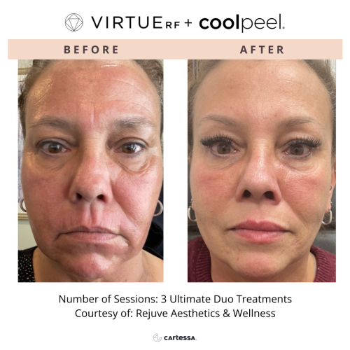 VirtueRF + CoolPeel | before and after photo | Coral Spring Med Spa | Coral Springs, FL