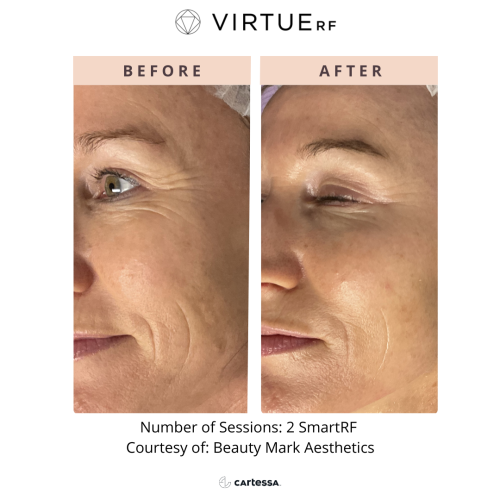 SmartRF Face | before and after photo | Coral Spring Med Spa | Coral Springs, FL