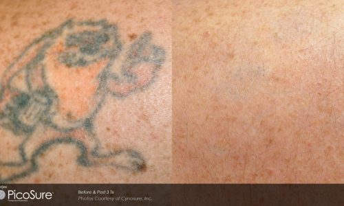 Tatto-removal Treatment before and after | Coral Springs Med Spa in Coral Springs, FL