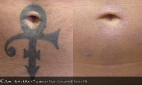 Tatto-removal Treatment before and after | Coral Springs Med Spa in Coral Springs, FL