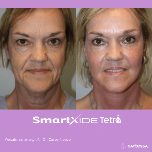 SmartXide Tetra CO2 laser resurfacing before and after Treatment | Coral Springs Med Spa in Coral Springs, FL