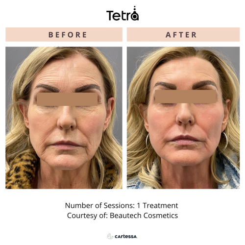 SmartXide Tetra CO2 laser resurfacing before and after Treatment | Coral Springs Med Spa in Coral Springs, FL