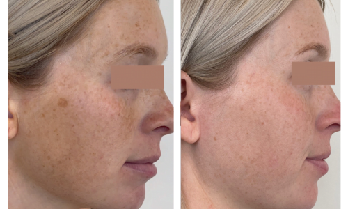 Cool Peel before and after Treatment | Coral Springs Med Spa in Coral Springs, FL