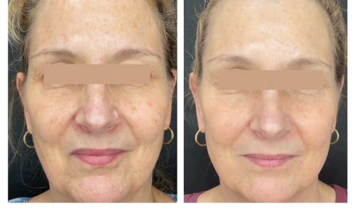 Cool Peel before and after Treatment | Coral Springs Med Spa in Coral Springs, FL