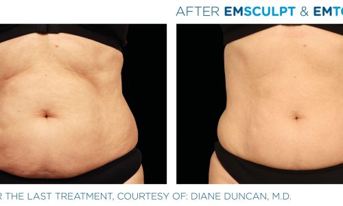 Emsculpt Neo before and after Treatment | Coral Springs Med Spa in Coral Springs, FL