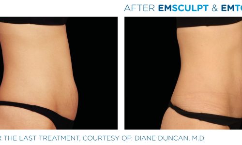 Emsculpt Neo before and after Treatment | Coral Springs Med Spa in Coral Springs, FL