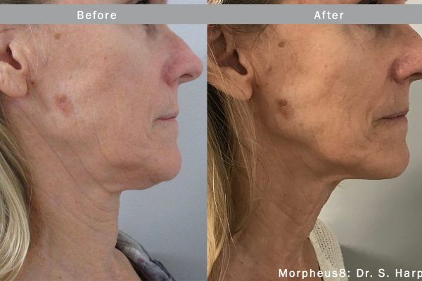 Morpheus8 Treatment before and after | Coral Springs Med Spa in Coral Springs, FL