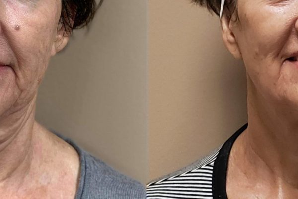 Morpheus8 Treatment before and after | Coral Springs Med Spa in Coral Springs, FL