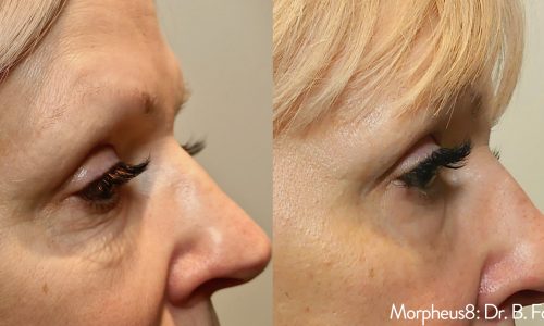 Morpheus8 Treatment before and after | Coral Springs Med Spa in Coral Springs, FL