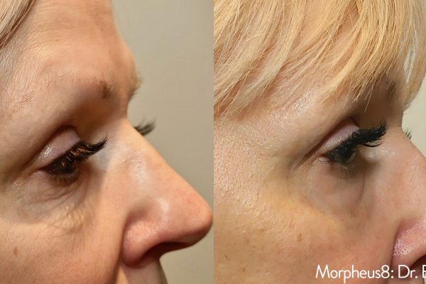 Morpheus8 Treatment before and after | Coral Springs Med Spa in Coral Springs, FL