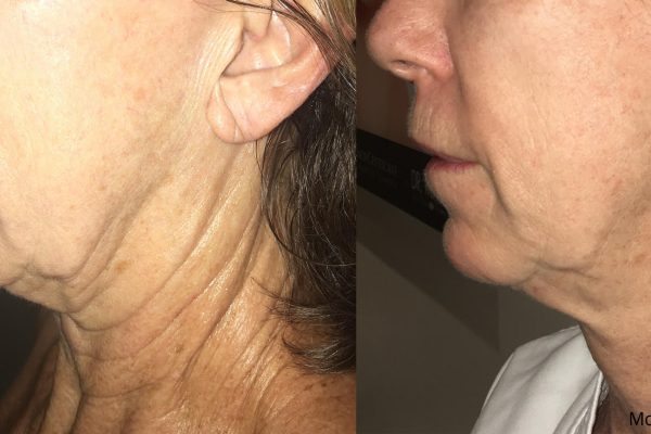 Morpheus8 Treatment before and after | Coral Springs Med Spa in Coral Springs, FL