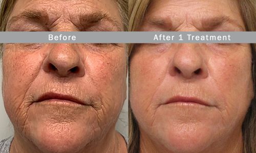Morpheus8 Treatment before and after | Coral Springs Med Spa in Coral Springs, FL