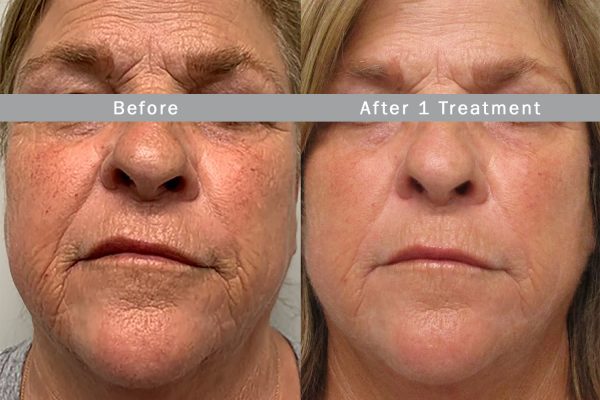 Morpheus8 Treatment before and after | Coral Springs Med Spa in Coral Springs, FL