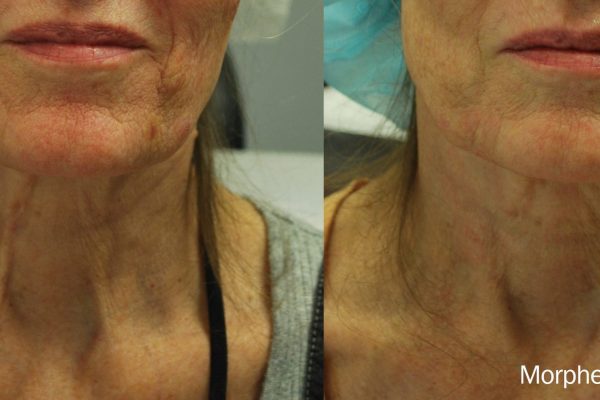 Morpheus8 Treatment before and after | Coral Springs Med Spa in Coral Springs, FL