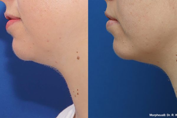 Morpheus8 Treatment before and after | Coral Springs Med Spa in Coral Springs, FL